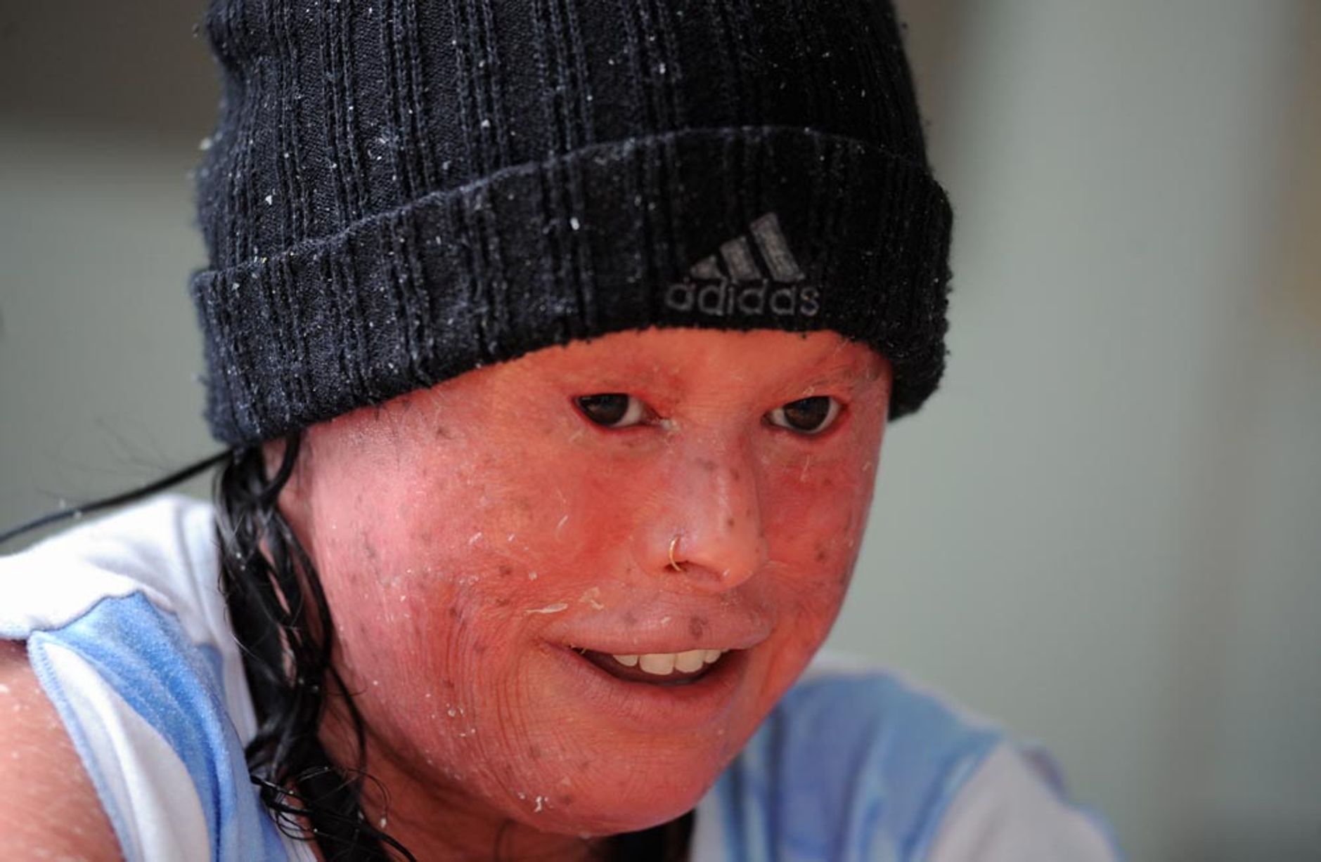 Редкий диагноз, уникальная судьба и особенное счастье Нелли Шахин